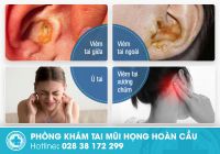 Các bệnh về tai và mức độ nguy hiểm cần chú ý