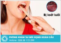 Tại sao bị loét lưỡi kéo dài? Cách chữa loét lưỡi hiệu quả bạn nên biết