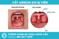 Cắt amidan là gì? Có đau không? Khi nào nên cắt amidan?