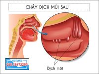 Chảy dịch mũi sau là triệu chứng của bệnh lý nào?