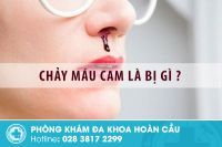 Chảy máu cam có thể xuất phát từ nhiều bệnh lý nguy hiểm