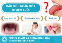 Những điều cần biết về bệnh viêm lưỡi bạn chớ bỏ qua