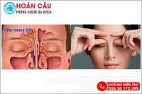 Đau nhức ở vùng trán cảnh báo bệnh viêm xoang trán nguy hiểm