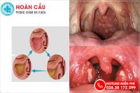 Đau rát cổ họng là triệu chứng của bệnh gì?