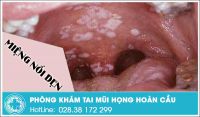 Miệng nổi đẹn có phải là bệnh nguy hiểm không?