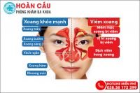 Nhận biết bệnh viêm xoang qua các dấu hiệu điển hình