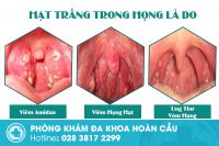 Hạt trắng trong họng là dấu hiệu bệnh gì? có nguy hiểm không?