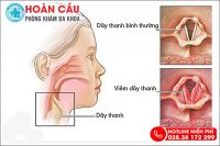 Khàn tiếng kéo dài - Cần cảnh giác với các bệnh lý nguy hiểm