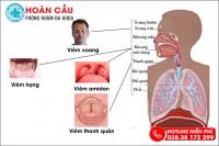 Cảnh báo triệu chứng khó nuốt nước bọt đau họng cực nguy hiểm