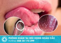 Lưỡi nổi mụn và những bệnh lý liên quan