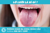 Làm thế nào khi bị lở lưỡi?