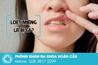 Loét miệng Nguyên nhân, triệu chứng và cách điều trị