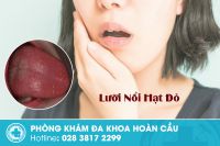 Chẩn đoán những bệnh lý khi lưỡi có hạt