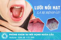 Lưỡi nổi hạt là bị bệnh gì? điều trị ra sao?