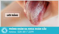 Phát hiện tình trạng lưỡi trắng, rát lưỡi không biết bị gì?