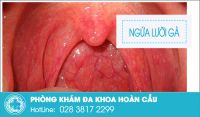 Ngứa lưỡi gà triệu chứng đơn giản nhưng nguy hiểm