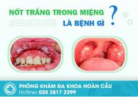 Nốt trắng trong miệng là bệnh gì? có nguy hiểm không?