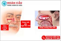 Polyp xoang hàm là gì bạn đã biết chưa?