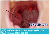 Cẩn thận khi bị sưng amidan