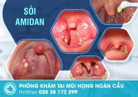 Chữa sỏi amidan bằng cách nào?