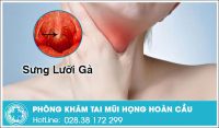 Tìm hiểu về bệnh sưng lưỡi gà và cách điều trị