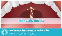 Sưng lưỡi gà triệu chứng bệnh cần cảnh giác