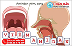 Triệu chứng viêm amidan không nên bỏ qua