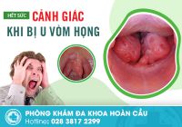 U vòm họng là bệnh gì? Triệu chứng và cách chữa trị
