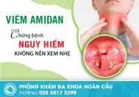 Viêm amidan - chữa ngay khi có những dấu hiệu này