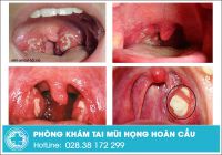 Rùng rợn với căn bệnh viêm amidan hốc mủ