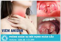 Viêm amidan là gì? có triệu chứng ra sao?