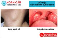 Nguyên nhân gây viêm amidan sưng hạch đáng kinh ngạc và cách điều trị