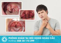 Dấu hiệu amidan xơ teo như thế nào? điều trị như thế nào?