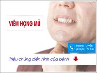 Viêm họng mủ: bệnh lý nguy hiểm không nên bỏ qua