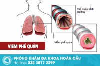 Viêm phế quản và những thông tin cần biết